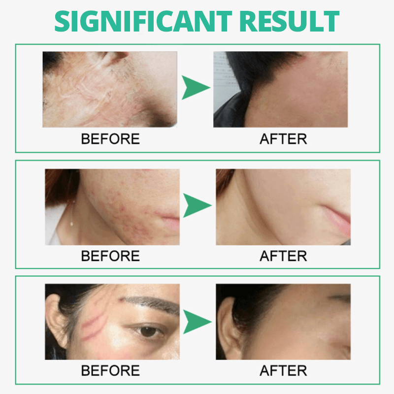 Scarless Skin Rebound Cream