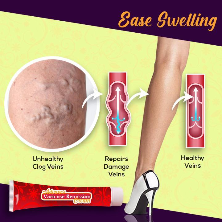 Advanced Varicose Remission Cream