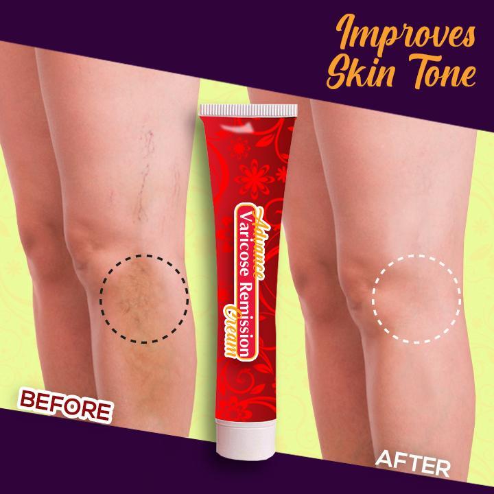 Advanced Varicose Remission Cream