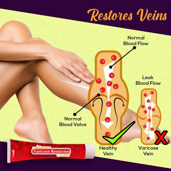 Advanced Varicose Remission Cream