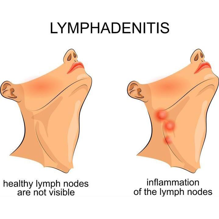 Nutrispot Neck Lymphatic Detox Patch